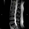 Columna Lumbar